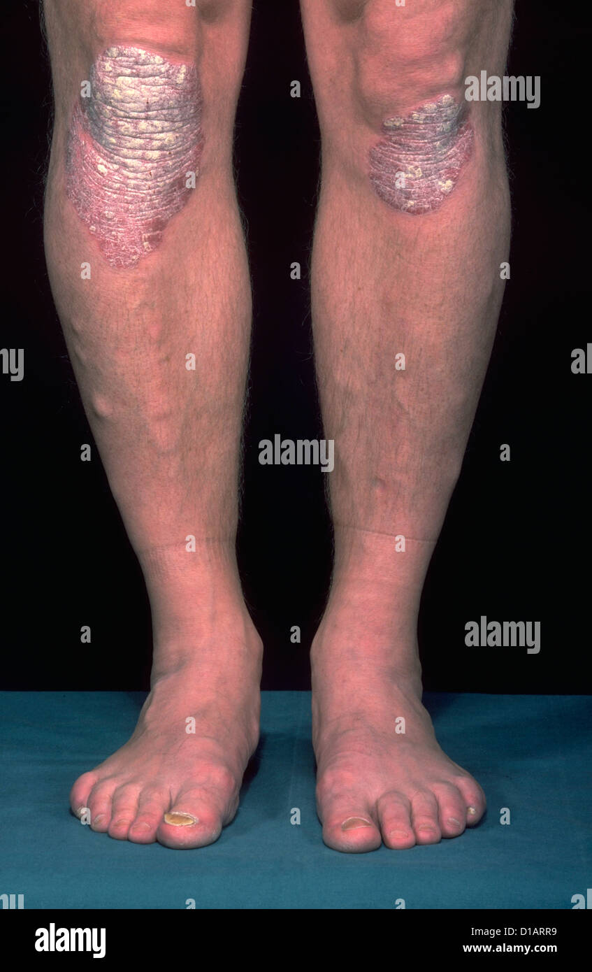 Plaque psoriasis hires stock photography and images Alamy