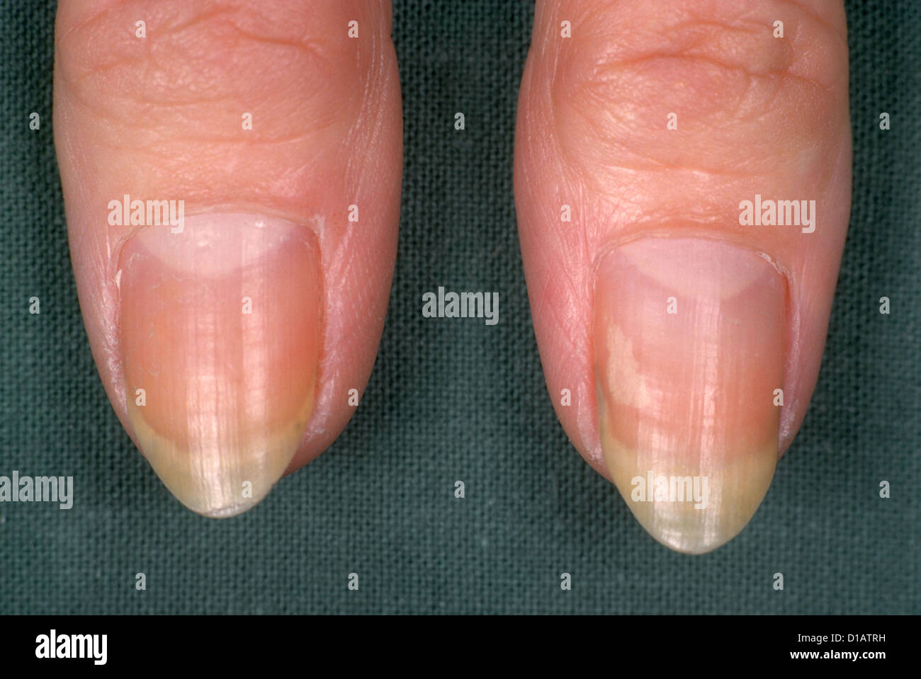 Habit Tic Nail Deformity - American Osteopathic College of Dermatology  (AOCD)