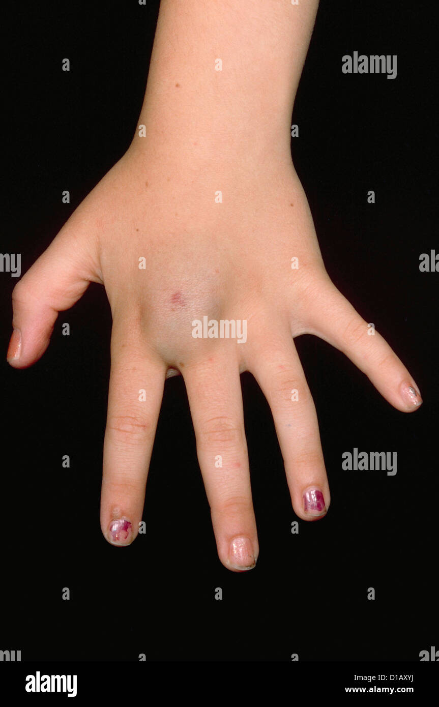 Venous malformation hi-res stock photography and images - Alamy