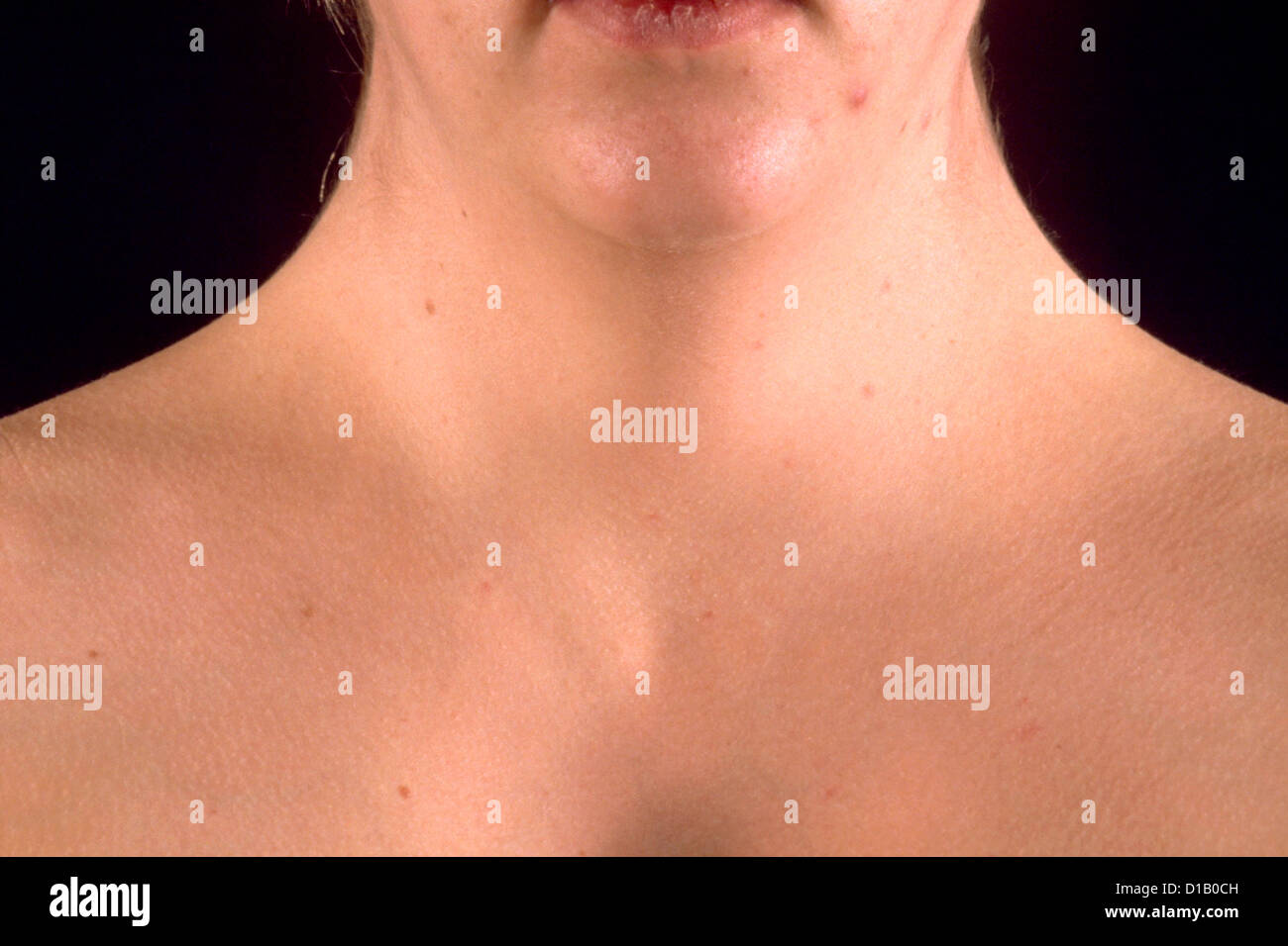 WEBBED NECK Stock Photo 52487585 Alamy