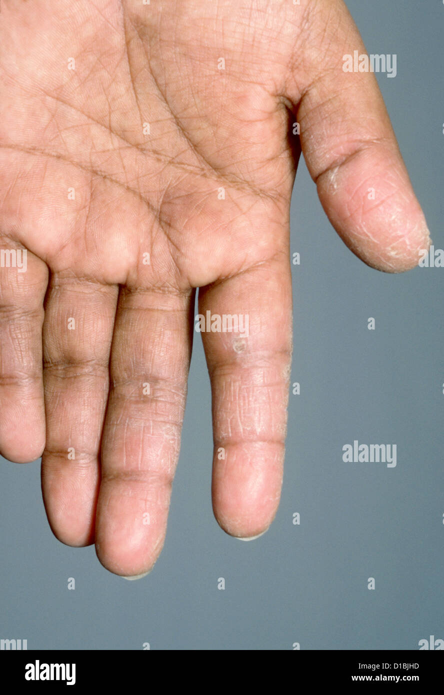HYPERKERATOSIS OF HANDS Stock Photo
