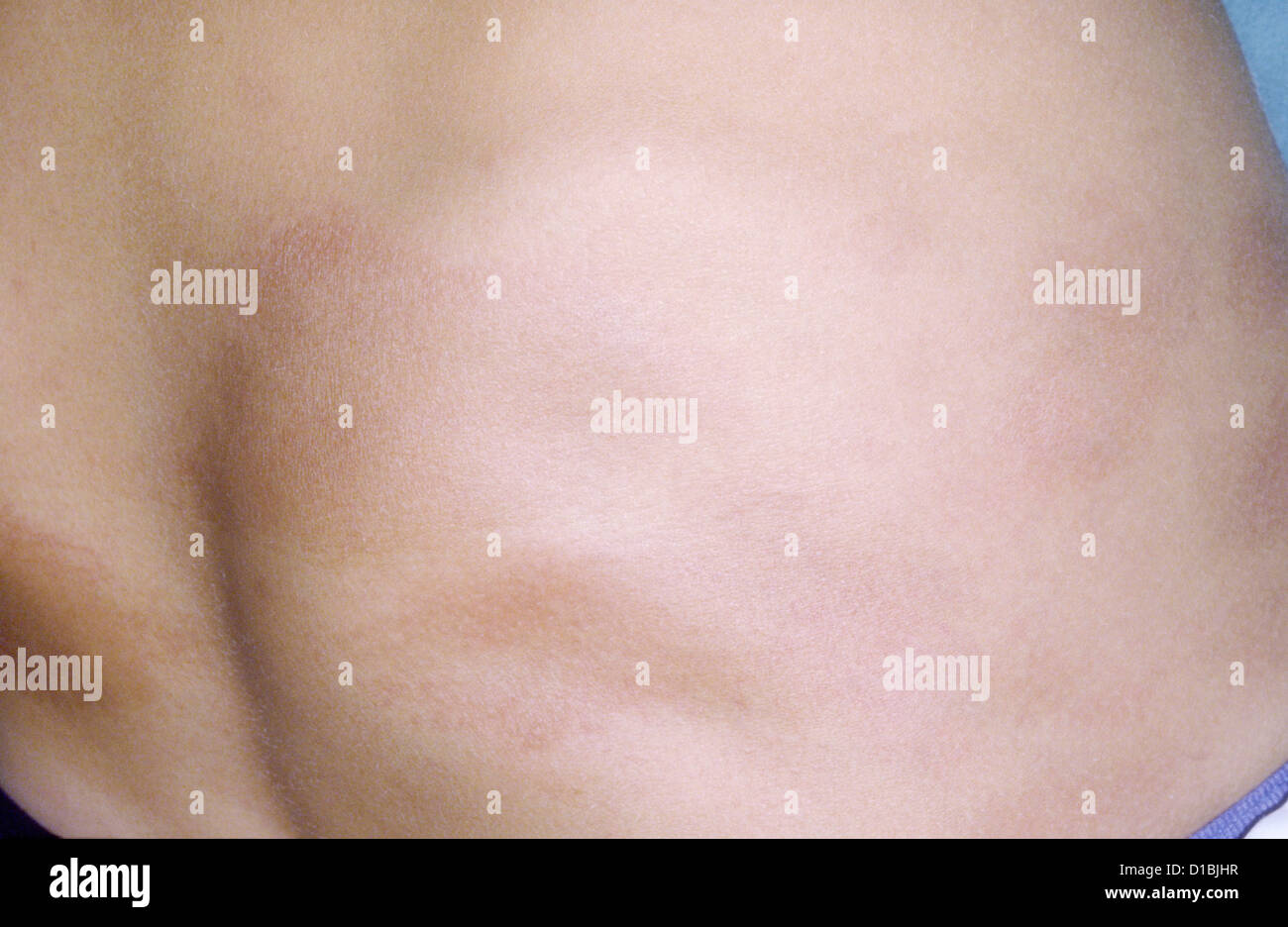 Atrophoderma hi-res stock photography and images - Alamy