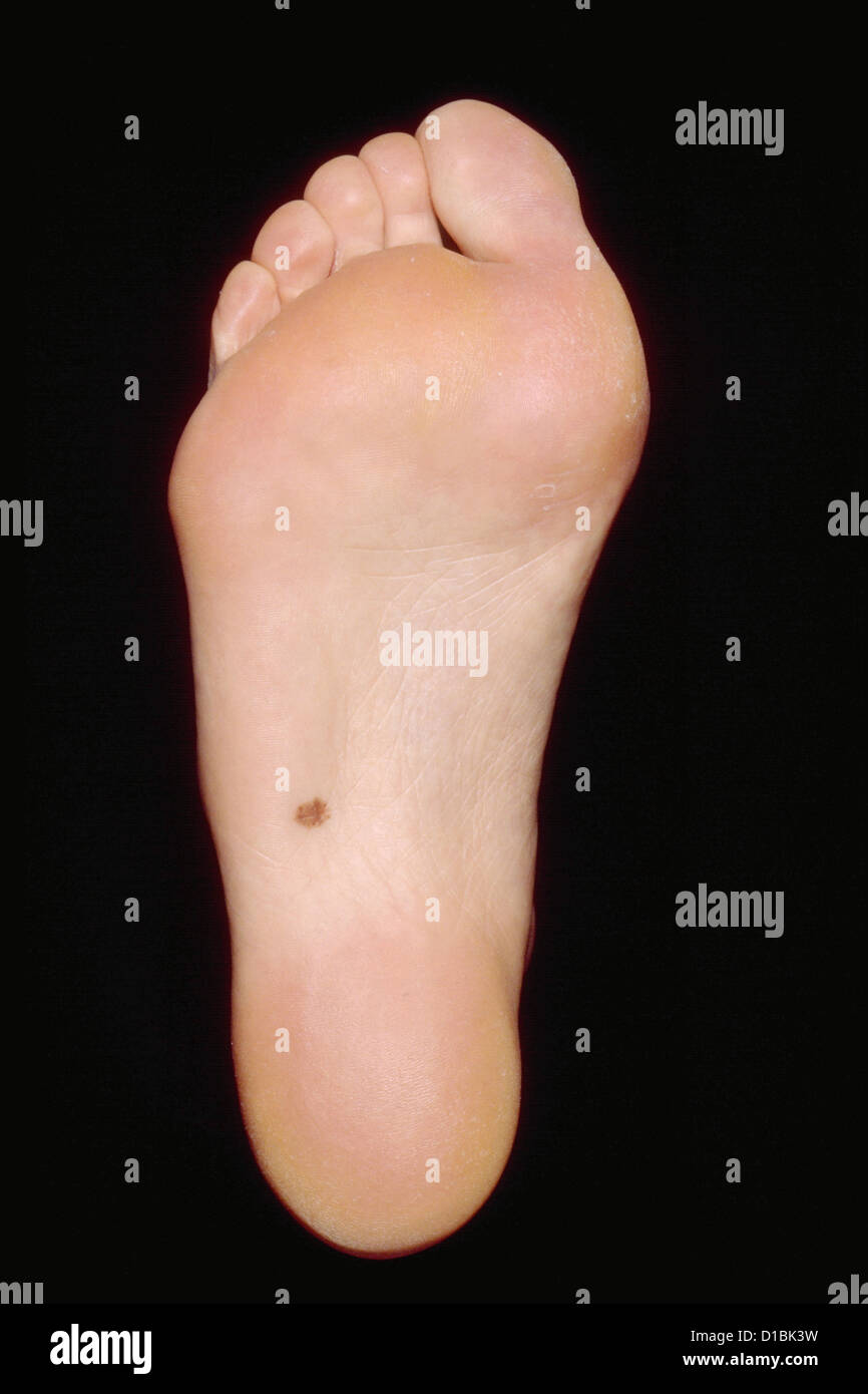 PIGMENTED LESION ON SOLE OF FOOT Stock Photo Alamy