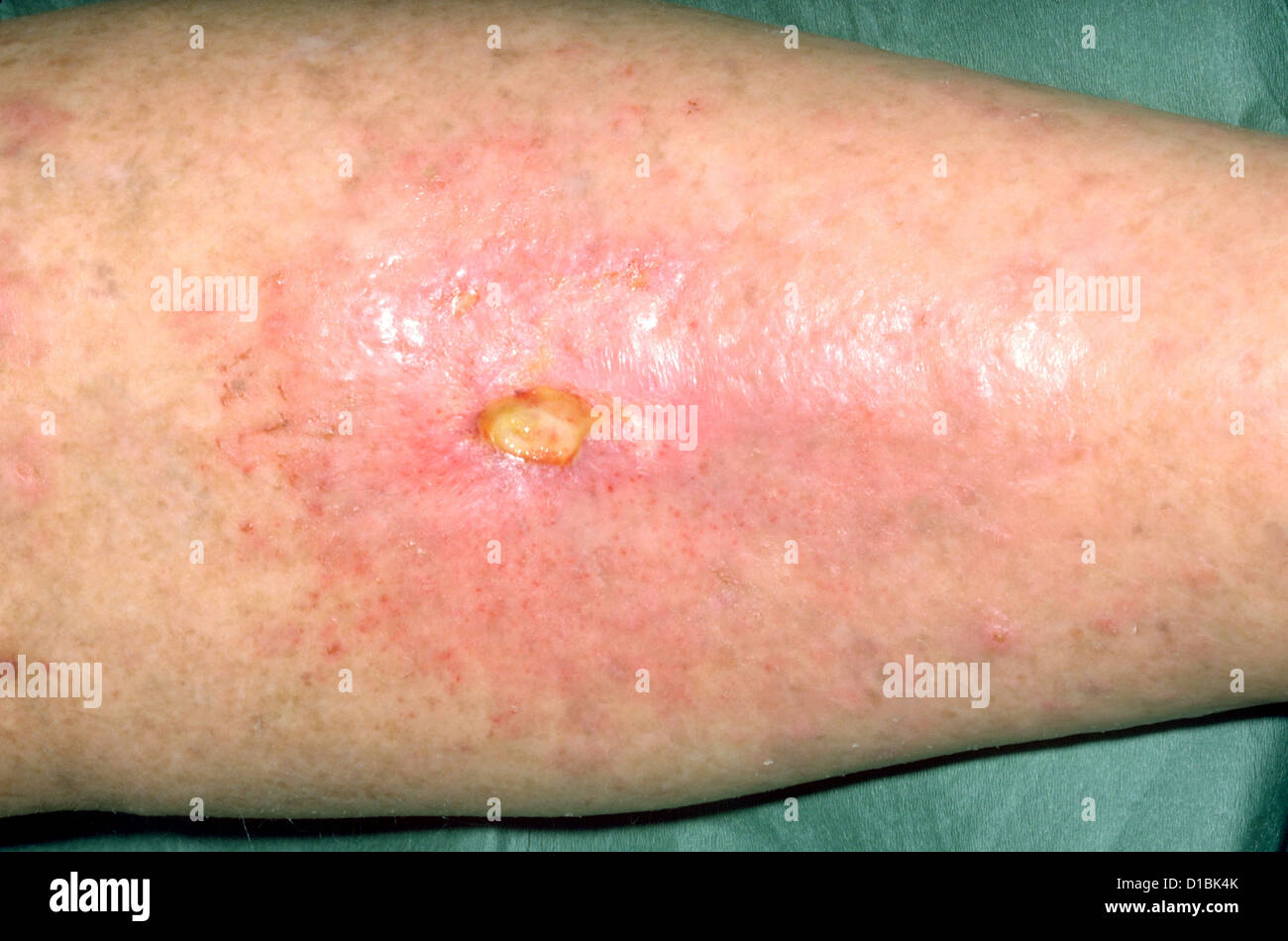RADIOTHERAPY ULCER ON LEG Stock Photo