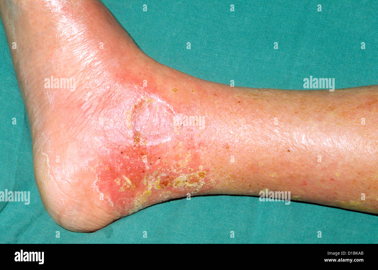 LEG ULCERS Stock Photo