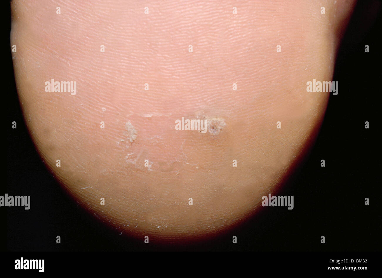 VIRAL WARTS ON SOLE OF FOOT Stock Photo Alamy
