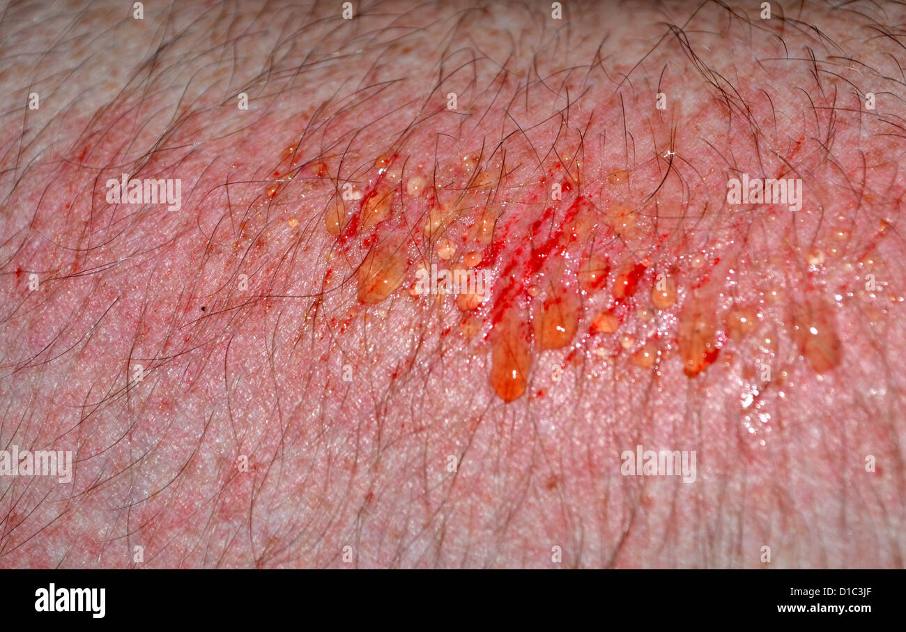 Pus Cells High Resolution Stock Photography and Images - Alamy