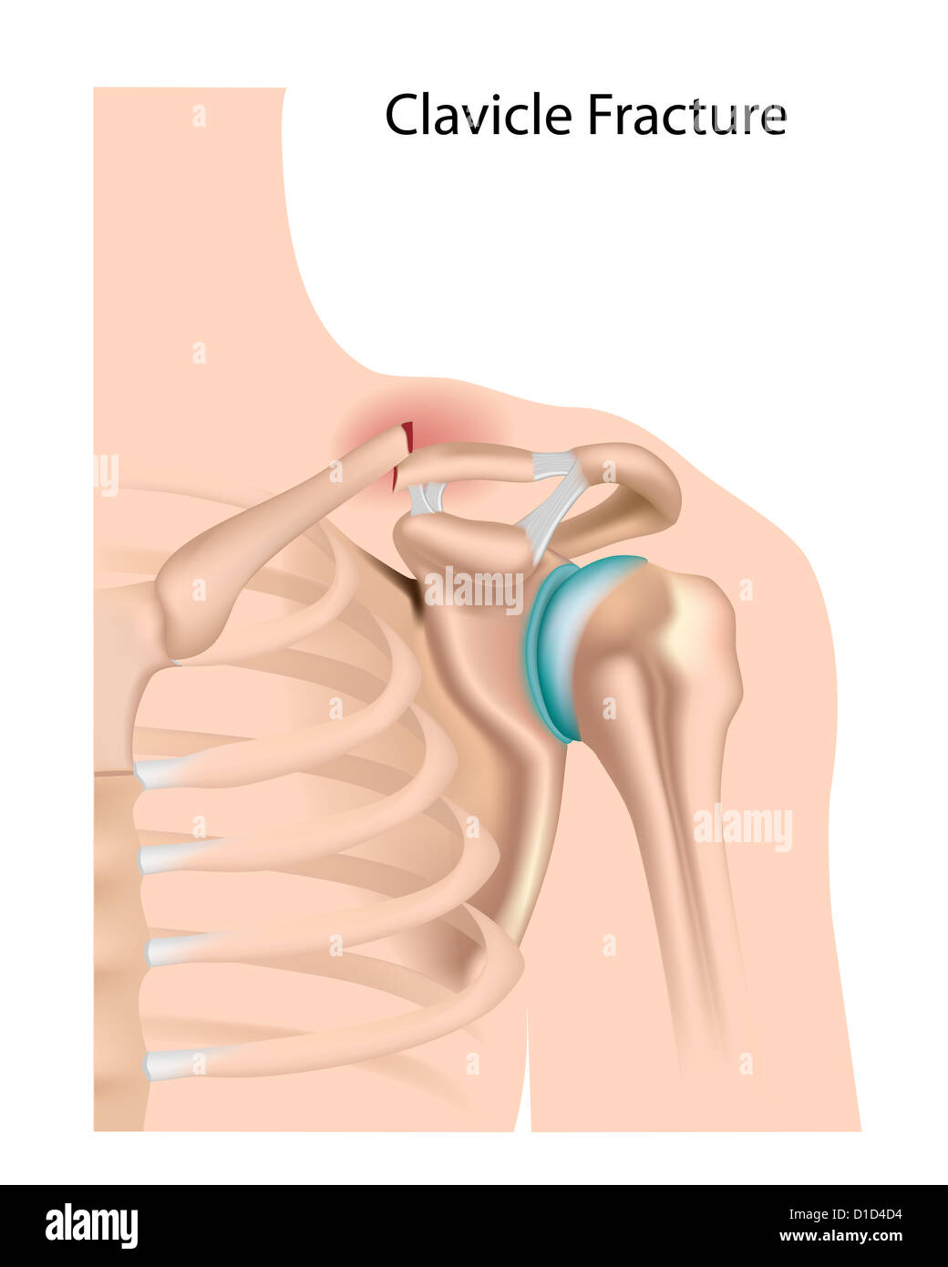 Clavicle fracture Stock Photo