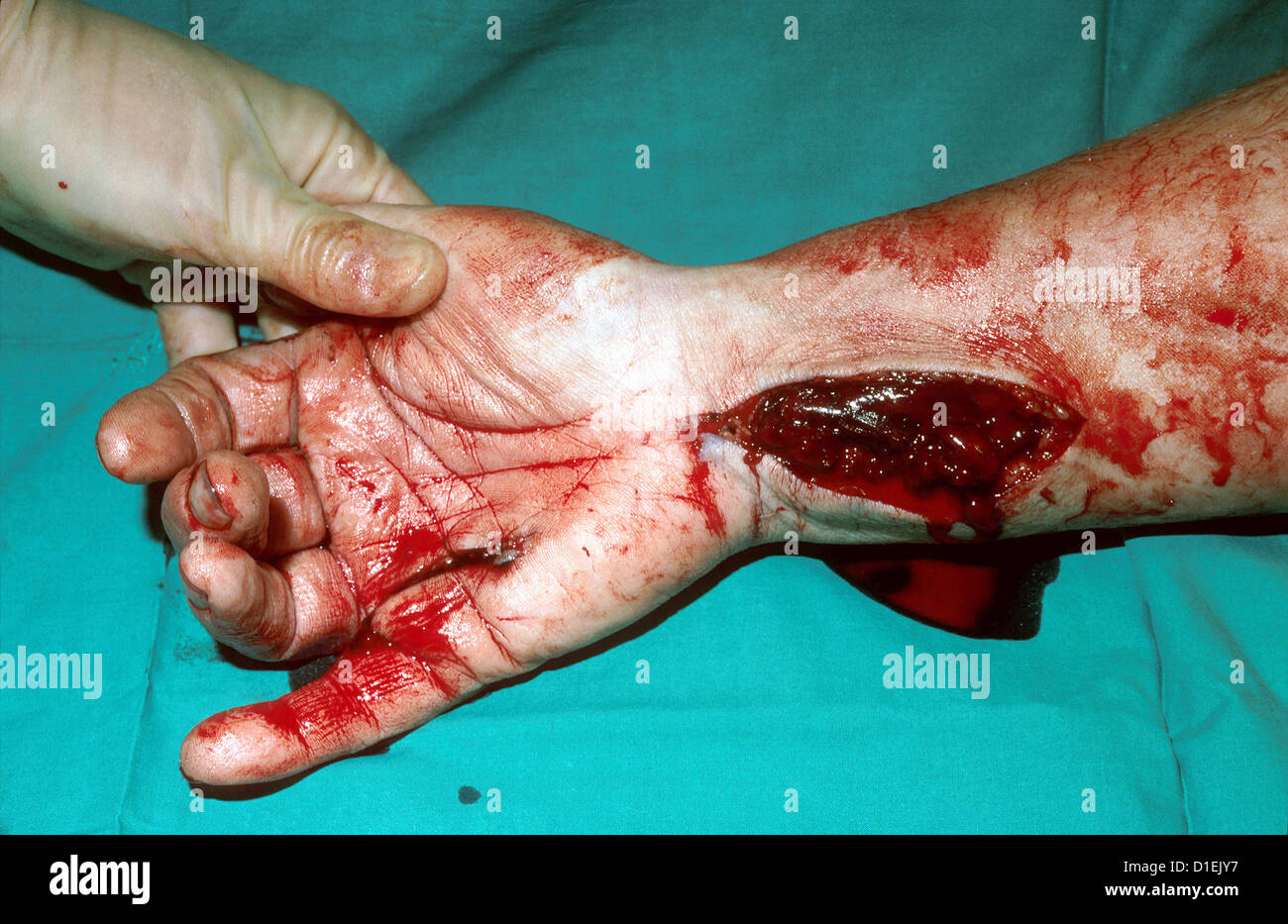 Lacerations of hand and arm.  Stock Photo