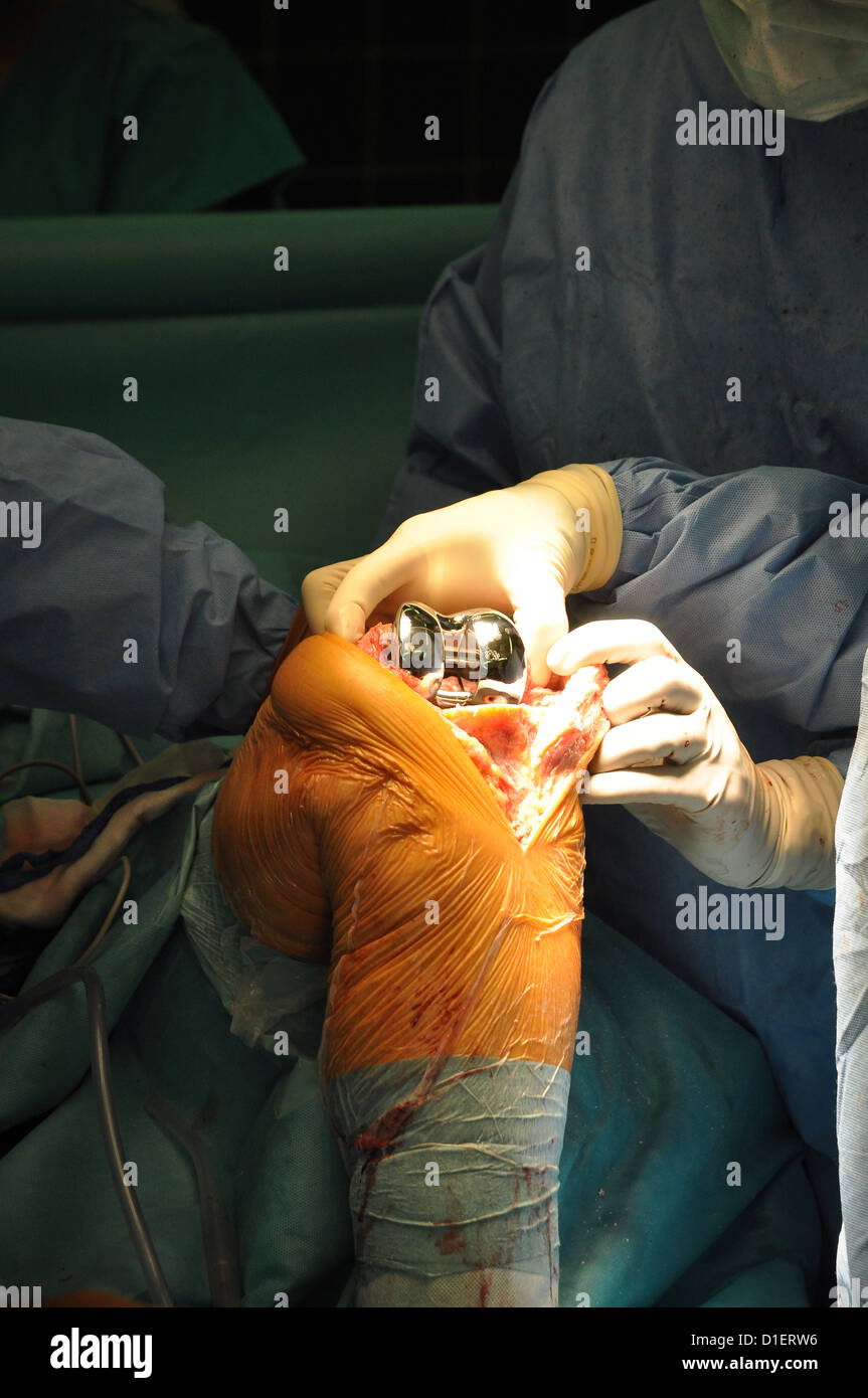 Prosthesis of the knee hospital operation Stock Photo