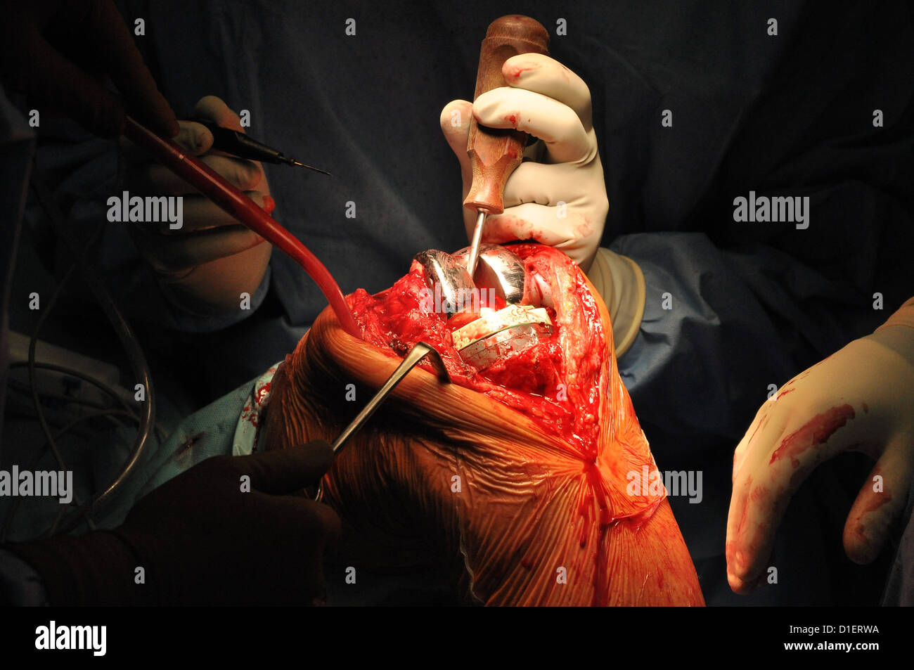 Prosthesis of the knee hospital operation Stock Photo