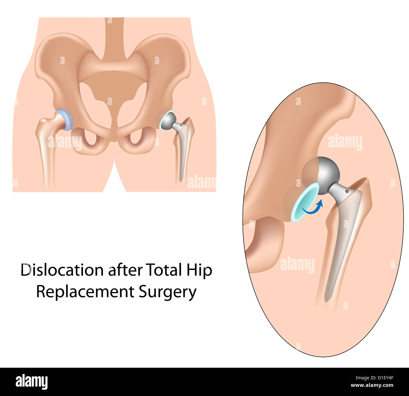 Dislocation after hip replacement surgery Stock Photo