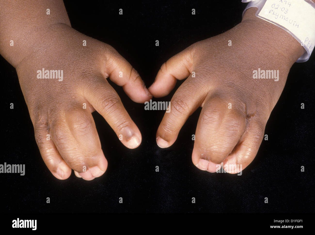 Syndactyly