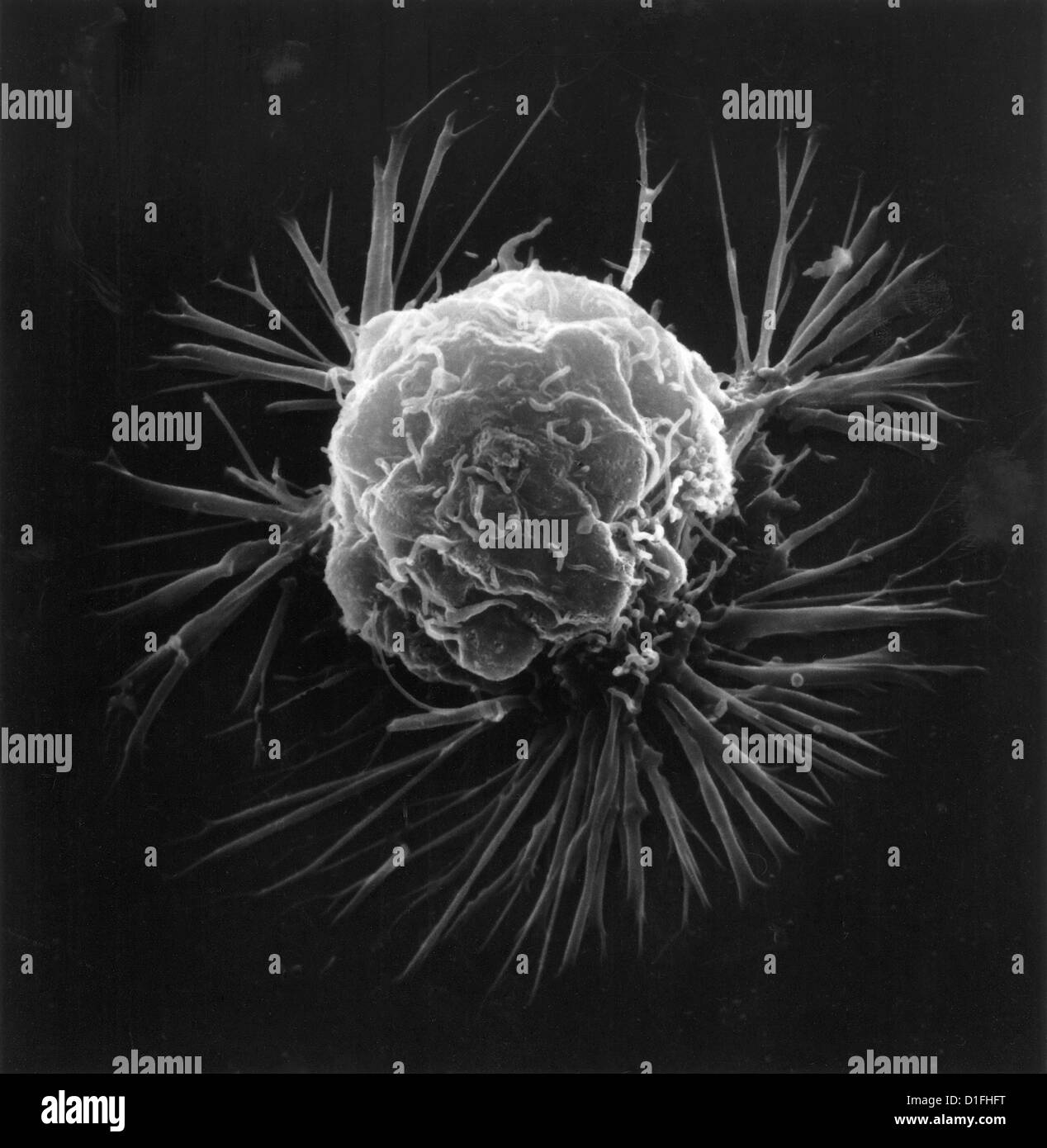 SEM - CANCER CELL Stock Photo