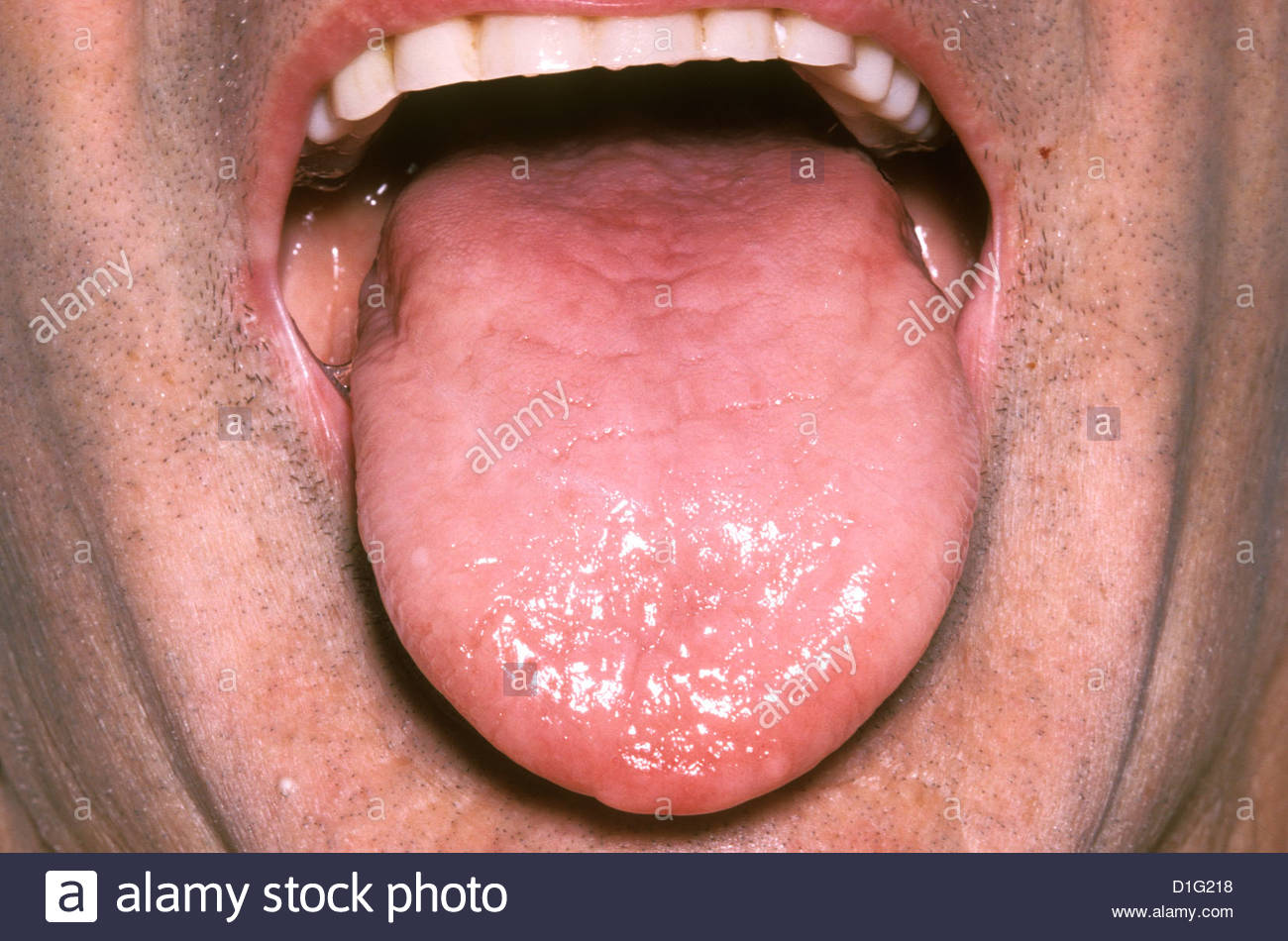 Anemia Tongue Stock Photos & Anemia Tongue Stock Images Alamy