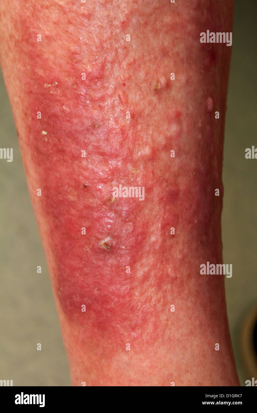 Severe Eczema or atopic dermatitis on an elderly man's leg Stock Photo
