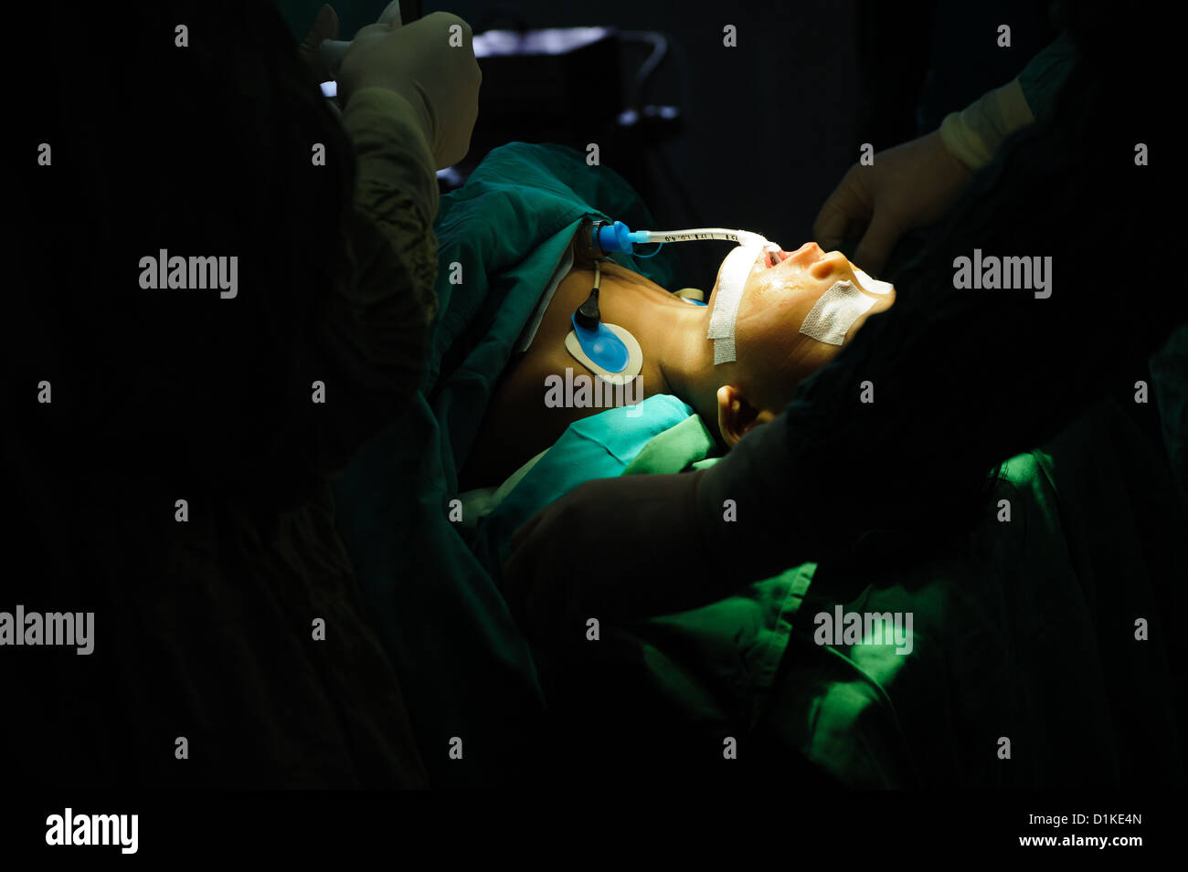 A young child lying in an operating theatre after surgery to repair a cleft in his soft palate, Bali, Indonesia. Stock Photo