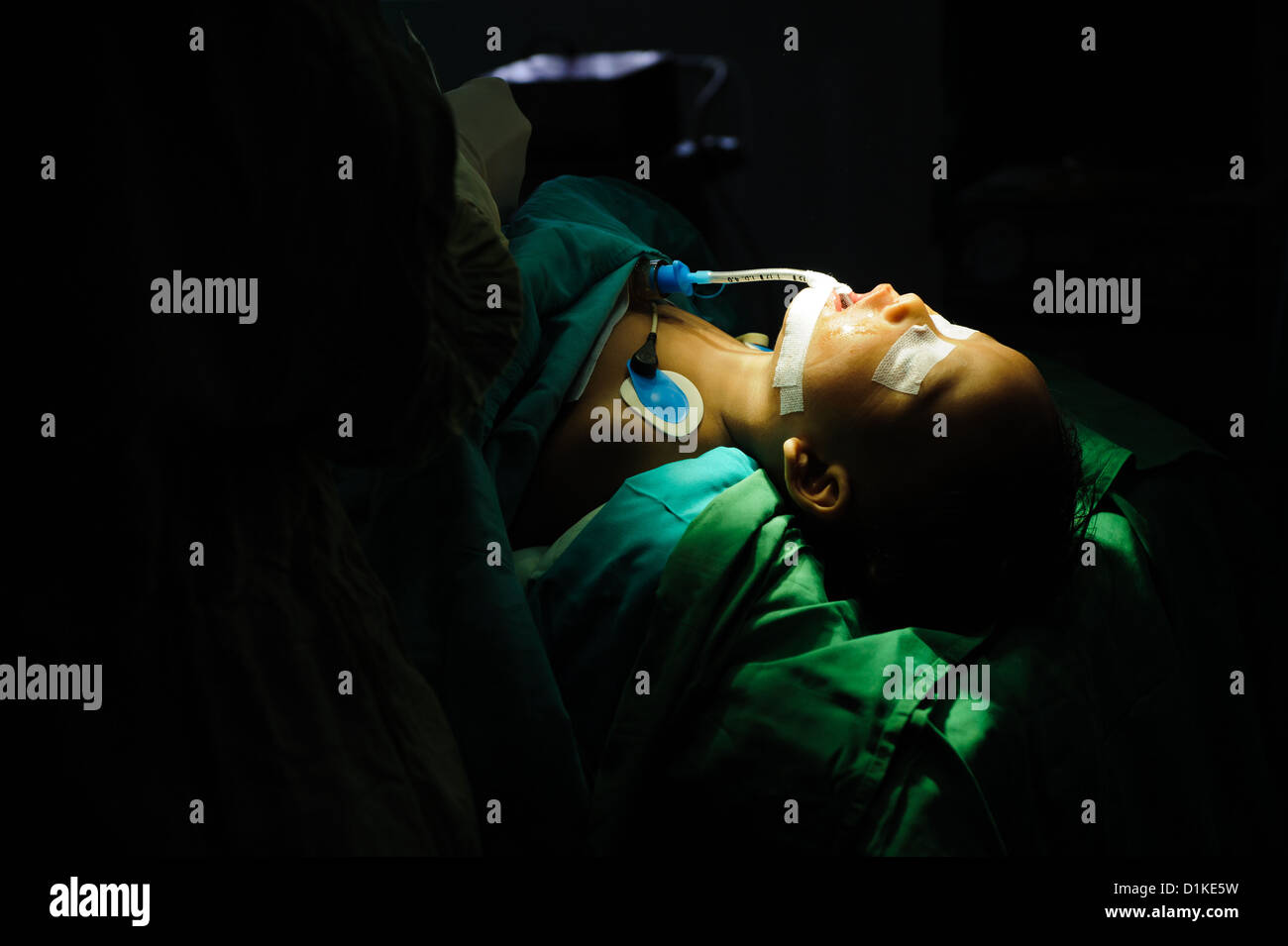 A young child lying in an operating theatre after surgery to repair a cleft in his soft palate, Bali, Indonesia. Stock Photo