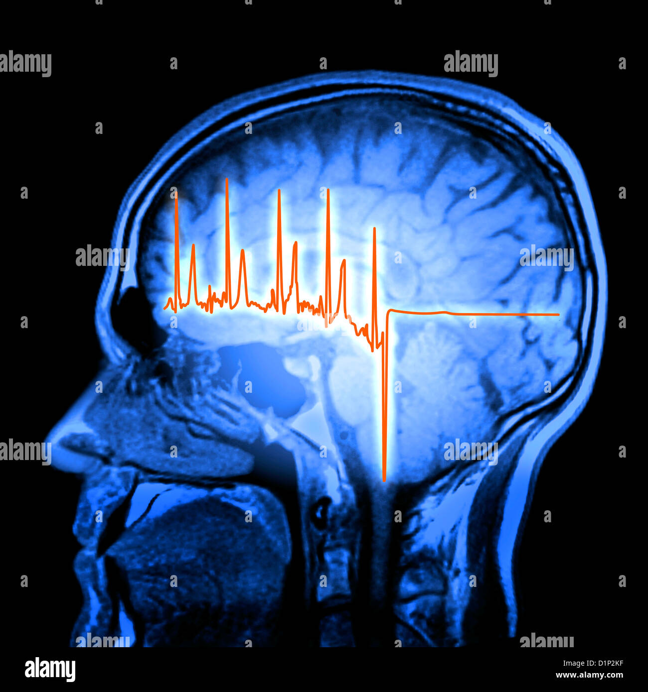 ECG trace and mri brain scan, artwork Stock Photo Alamy