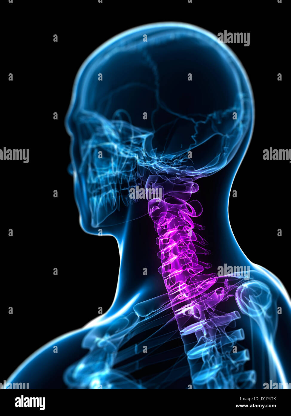 Neck pain, conceptual artwork Stock Photo