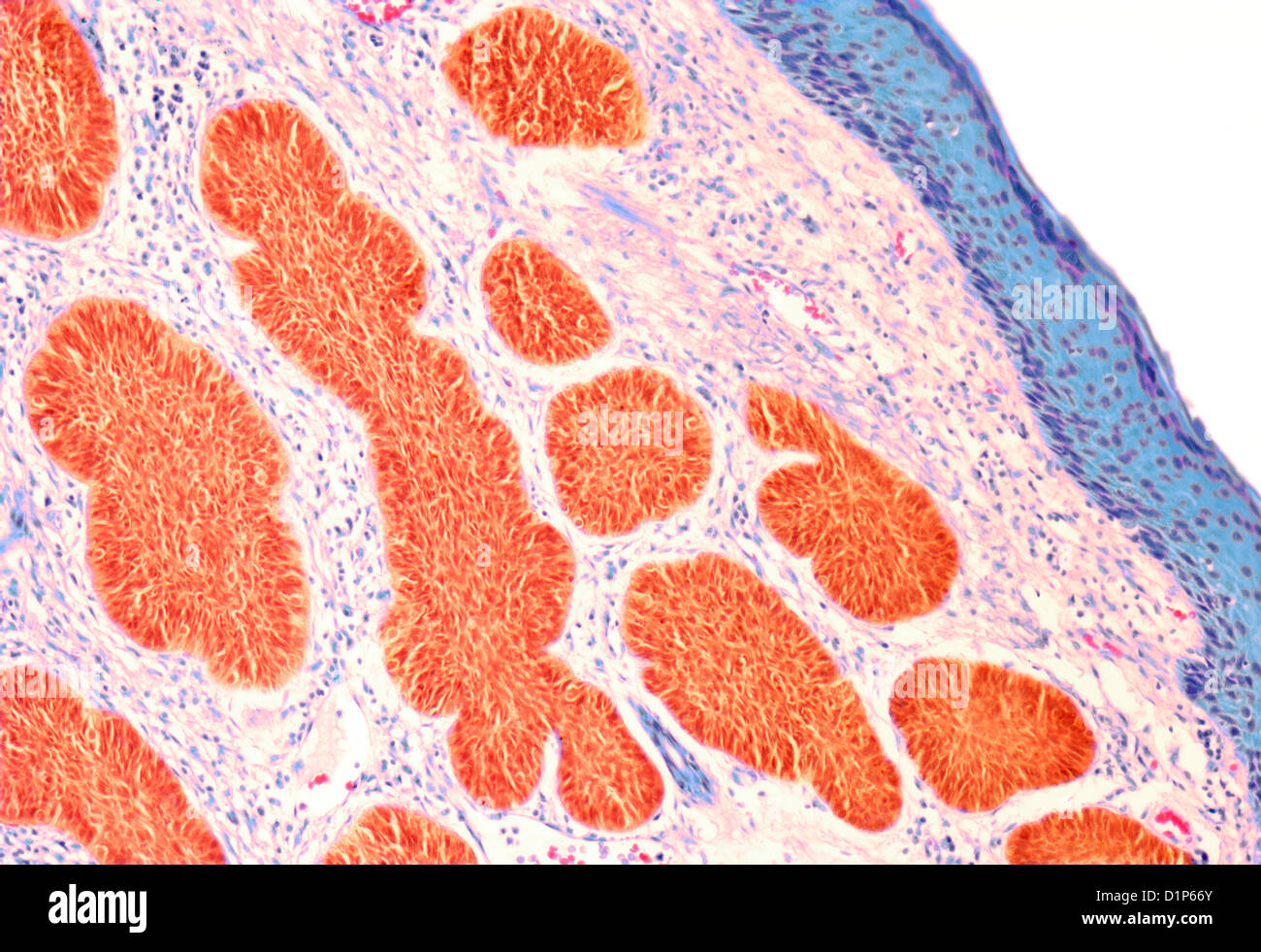 Skin cancer, light micrograph Stock Photo