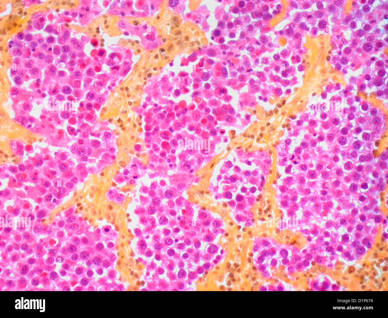 Testicular cancer, light micrograph Stock Photo