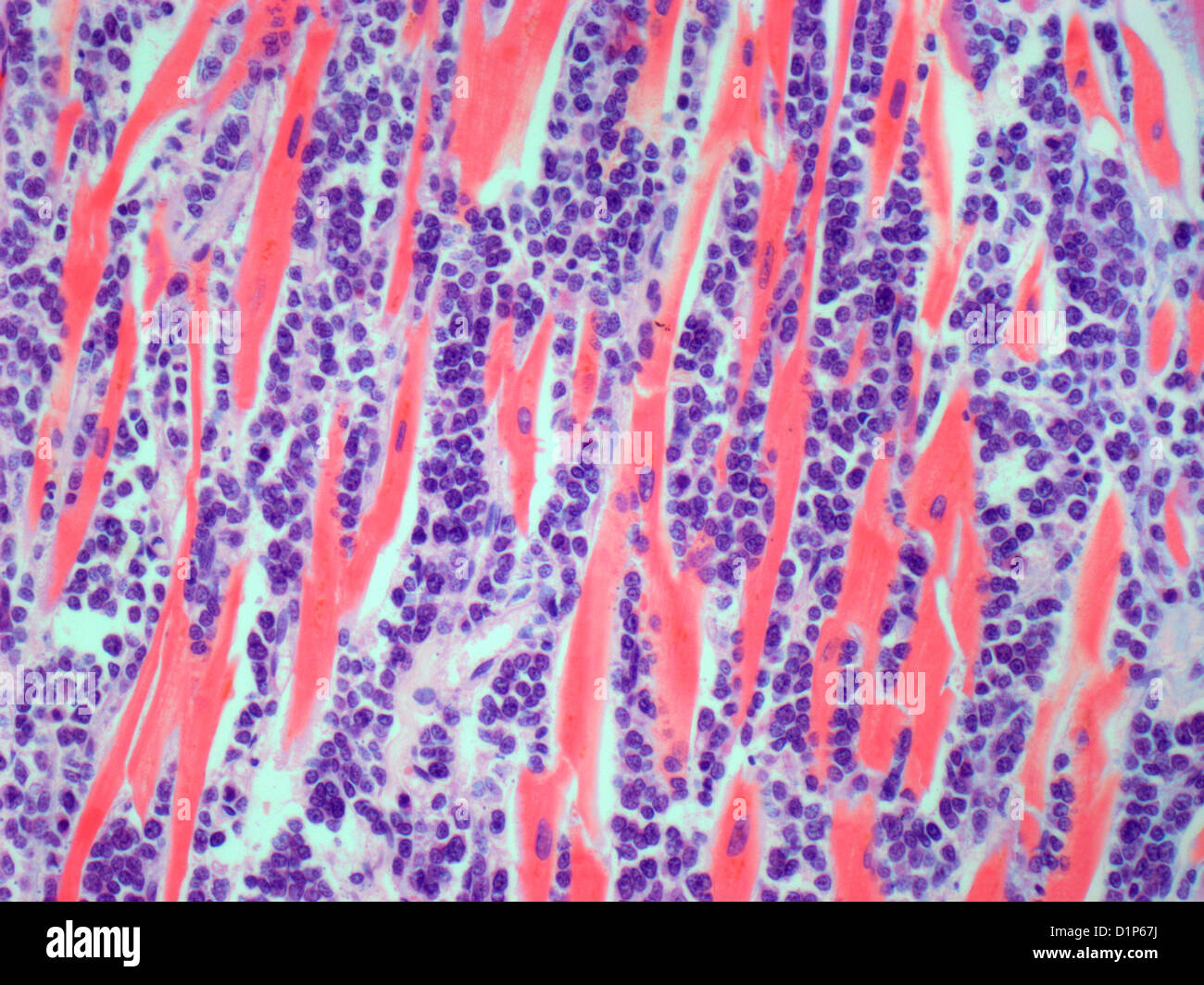 Secondary heart cancer, light micrograph Stock Photo