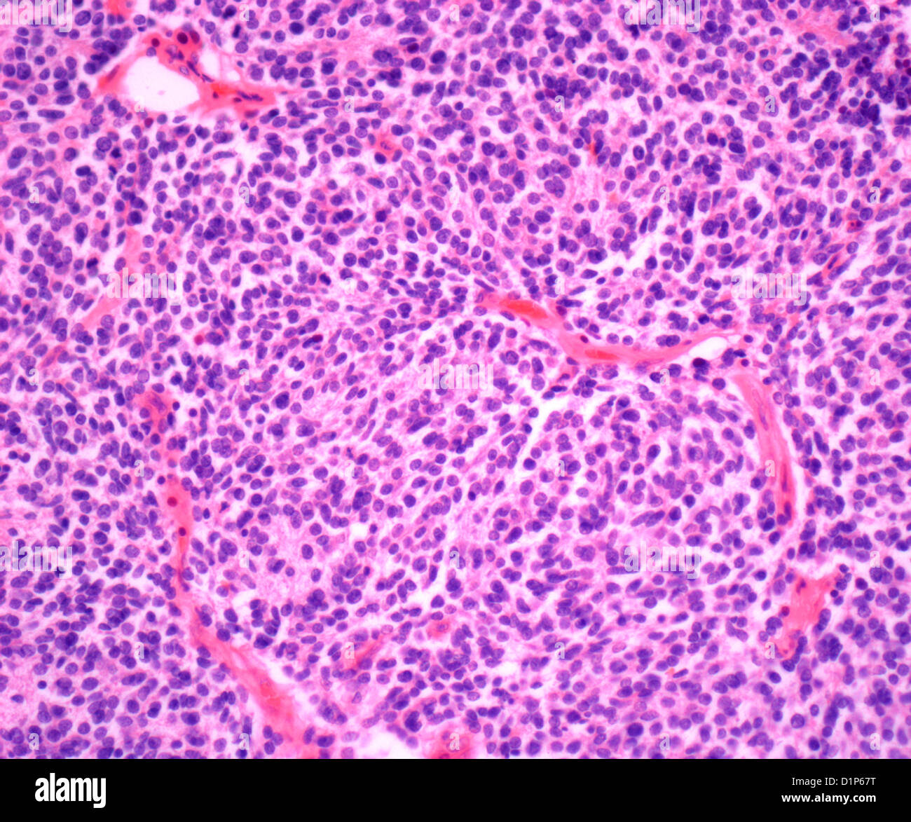 Kidney cancer, light micrograph Stock Photo