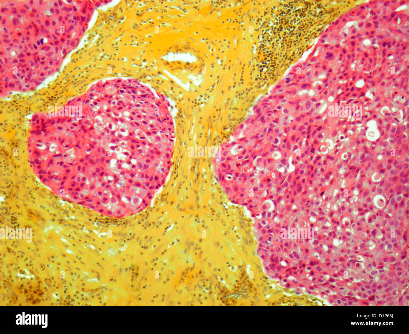 Breast cancer, light micrograph Stock Photo