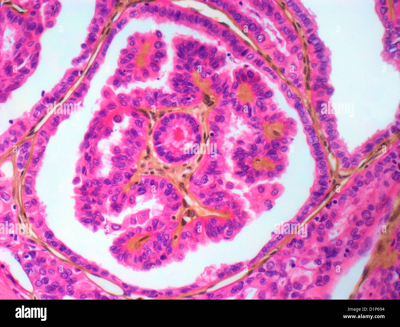Thyroid cancer, light micrograph Stock Photo