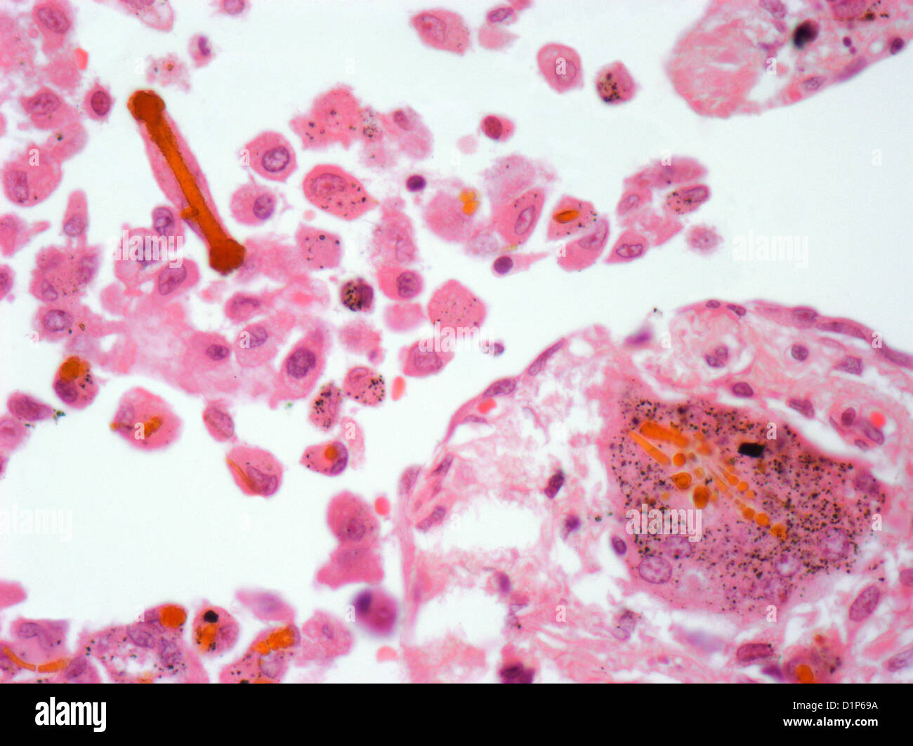 Asbestos in lung tissue, light micrograph Stock Photo