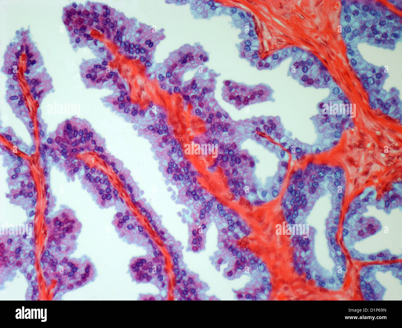 Prostate cancer, light micrograph Stock Photo