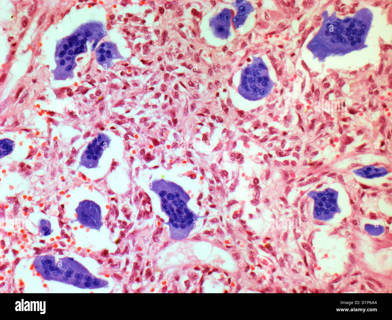 Bone tumour, light micrograph Stock Photo