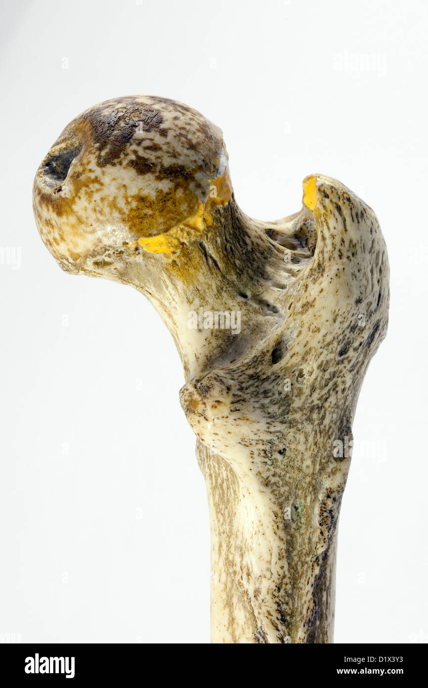 Femur bone human, close up of upper part to show the neck of femur, the commonest part to fracture - Right femur, posterior view Stock Photo