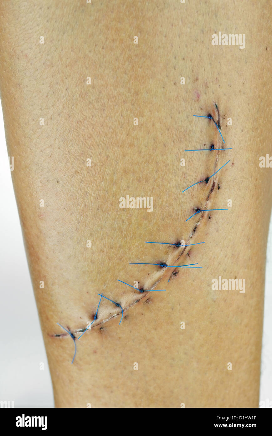 Scar on leg hi-res stock photography and images - Alamy