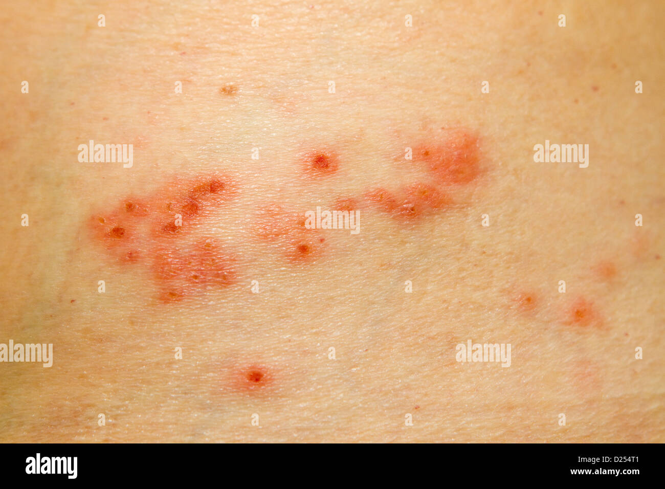 Mild case of shingles rash on the side of the body Stock Photo - Alamy