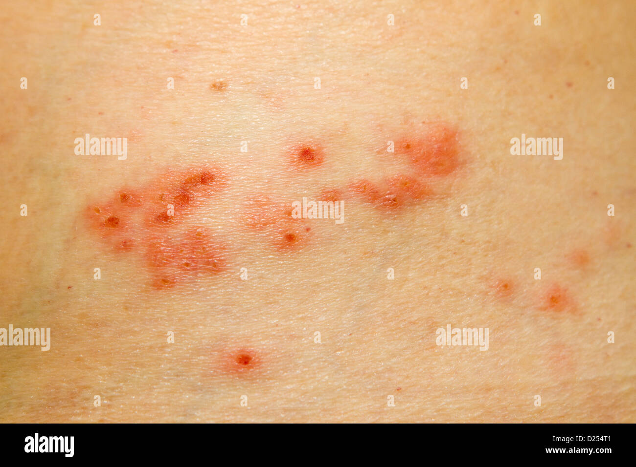 Shingles on spine