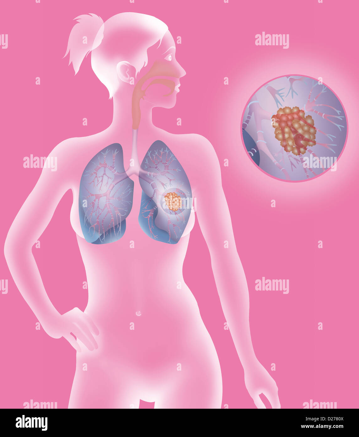 LUNG CANCER, DRAWING Stock Photo Alamy