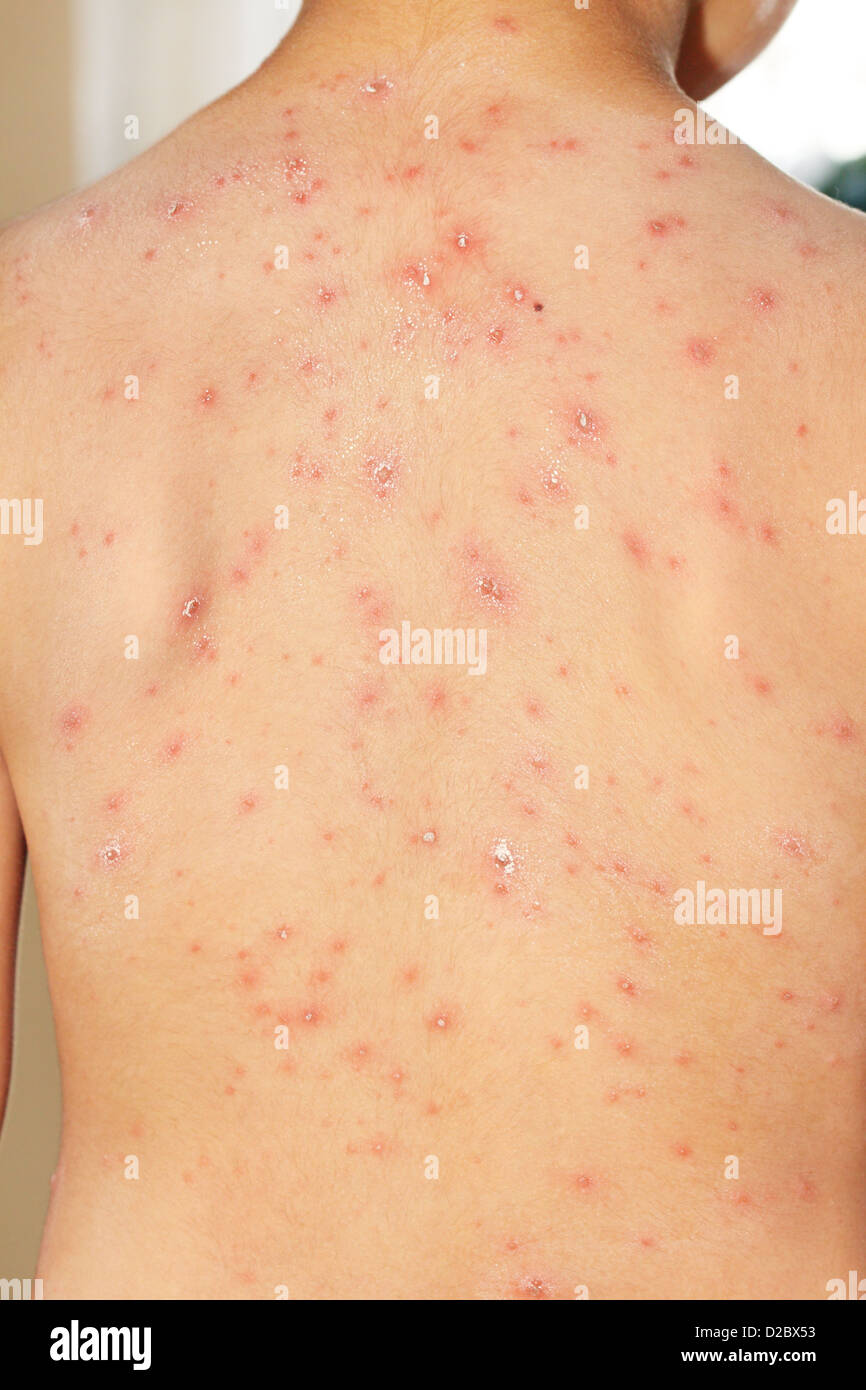 Baby boy with chicken pox rash Stock Photo - Alamy