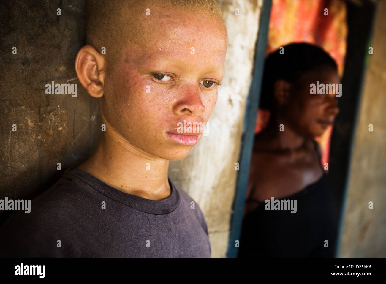 Teenage african albino boy and his mother. Stock Photo