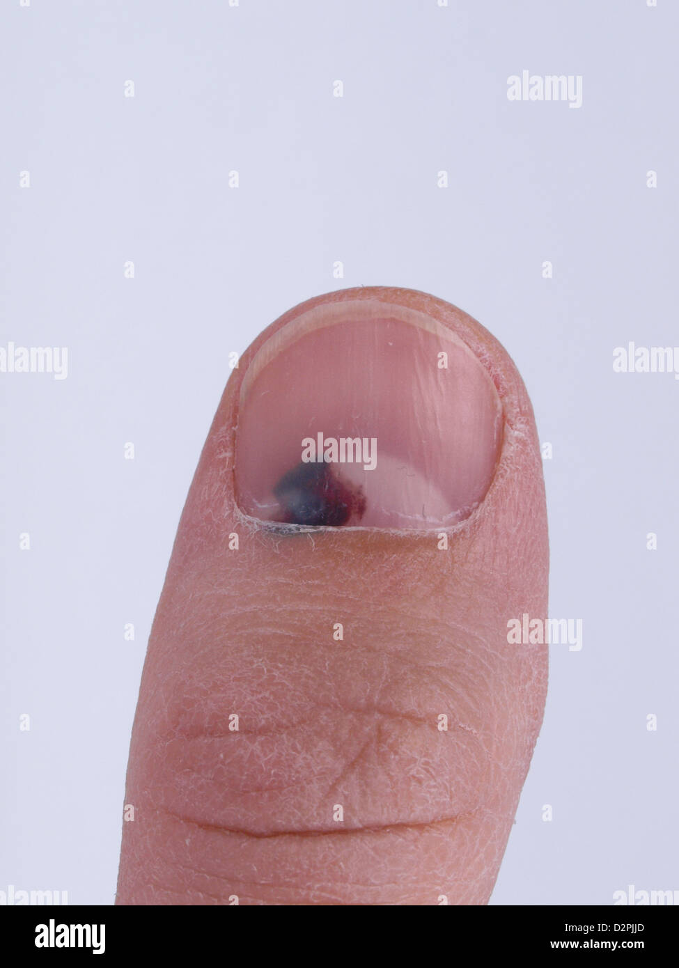 Subungual Hematoma Collection Of Blood Underneath Fingernail Black Toenail Medical Condition Aka Runner Or Tennis Toe Stock Photo Alamy Subungual Hematoma Collection Of Blood Underneath Fingernail Black Toenail Medical Condition Aka Runner Or Tennis Toe Stock Photo Alamy