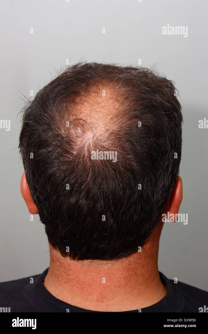 Male head with hair loss symptoms back side Stock Photo - Alamy
