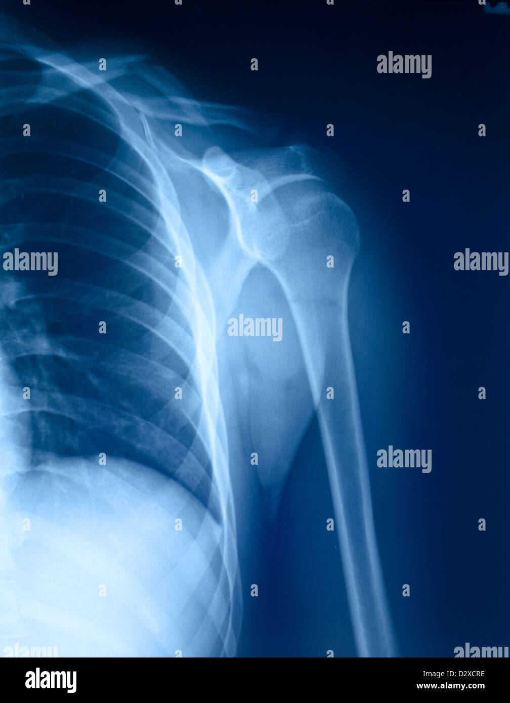 Xray film of shoulder fracture Stock Photo Alamy