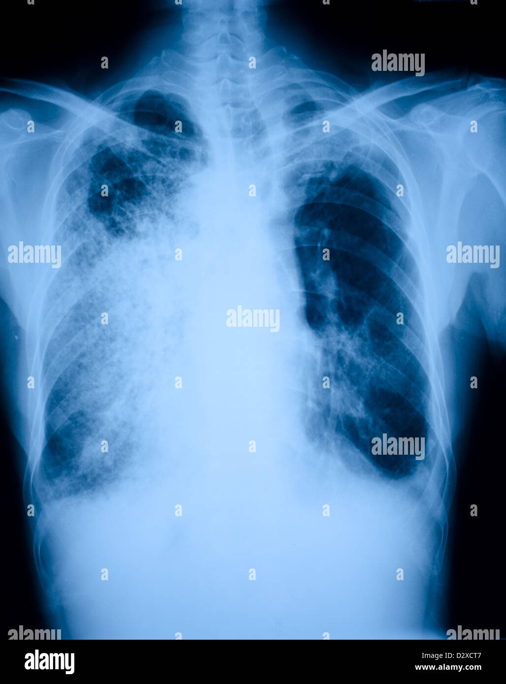 Pneumonia patients x-ray film Stock Photo