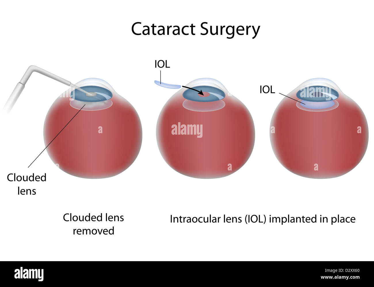 Cataract surgery Stock Photo