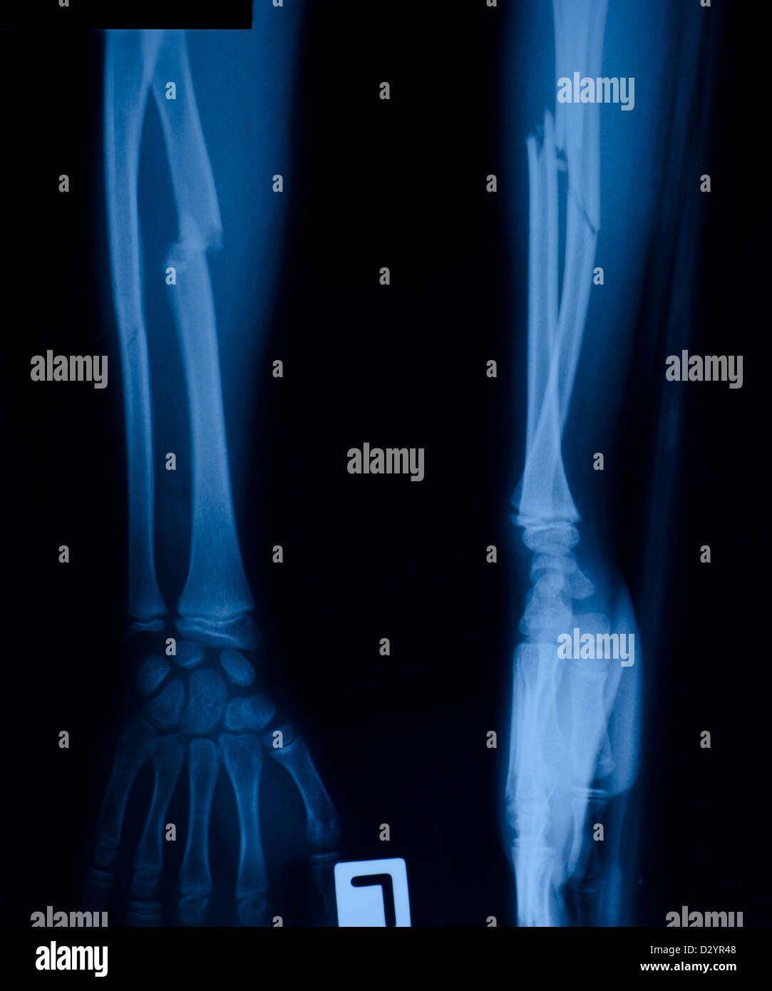 X ray film of proximal radius fracture Stock Photo