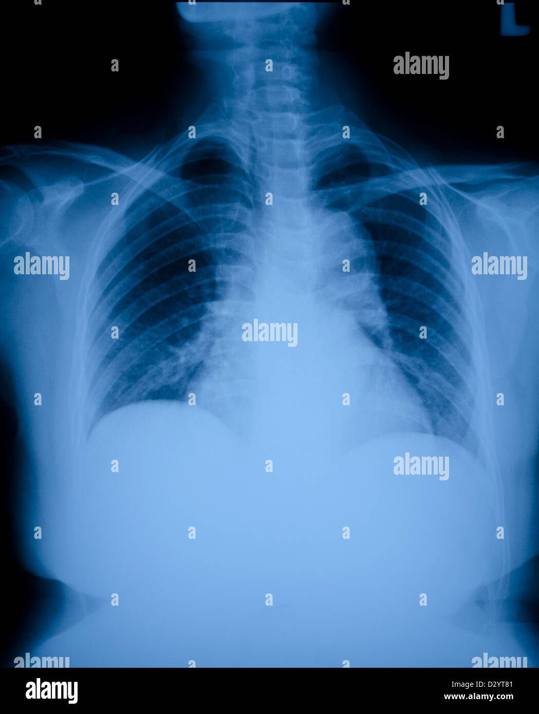 Pneumonia patients x-ray film. Stock Photo