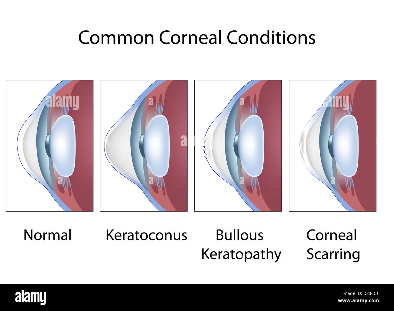Common corneal conditions Stock Photo