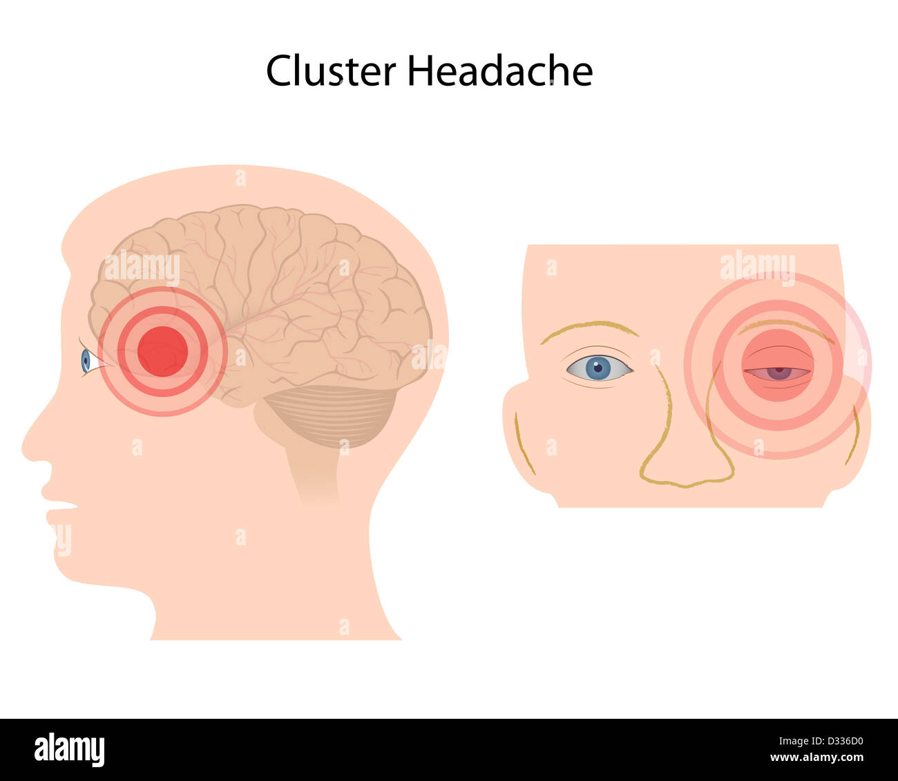 Cluster headache Stock Photo