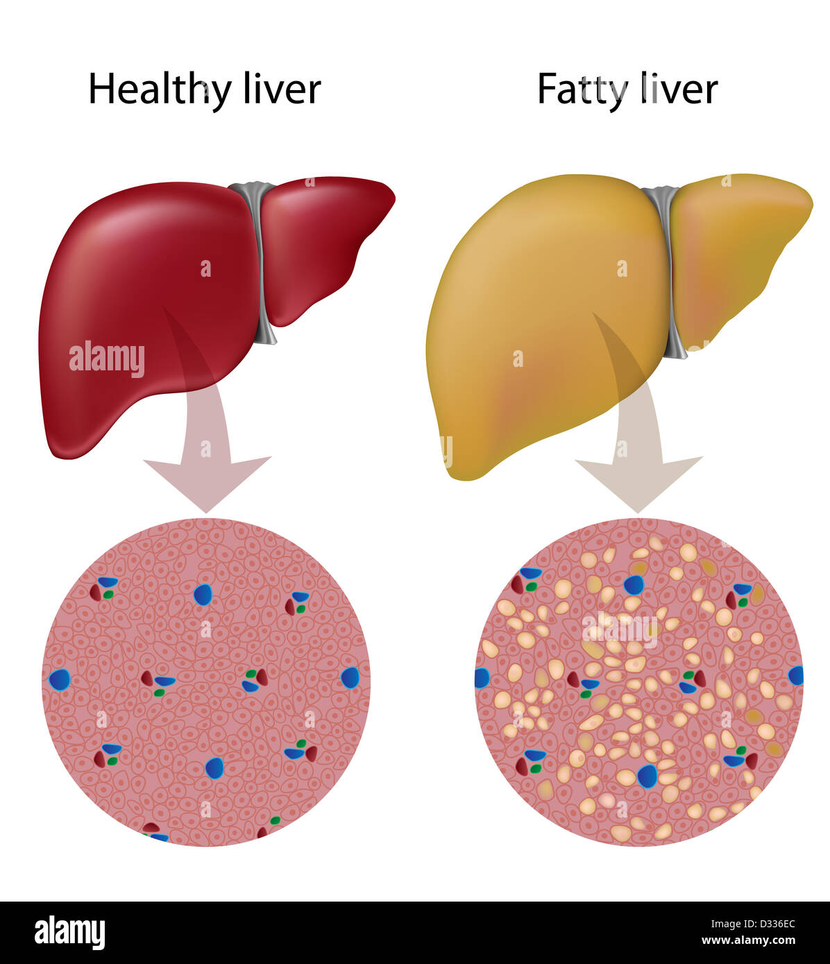 Fatty liver Stock Photo - Alamy